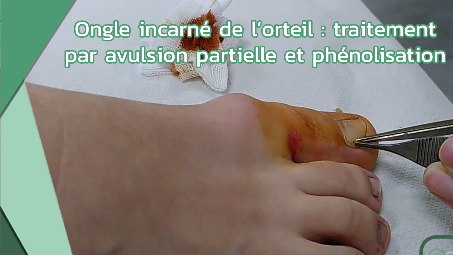 Ongle incarné de l’orteil traitement par avulsion partielle et phénolisation thumbnail